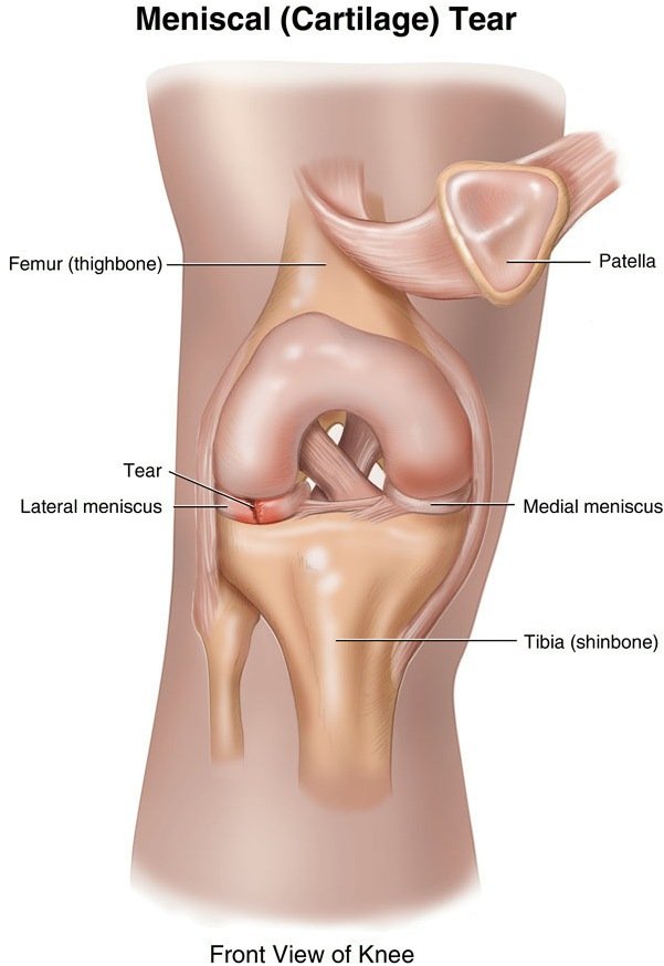Visual representation of a knee with a meniscus cartilage tear, illustrating the benefits of using a knee brace for meniscus tear treatment.
