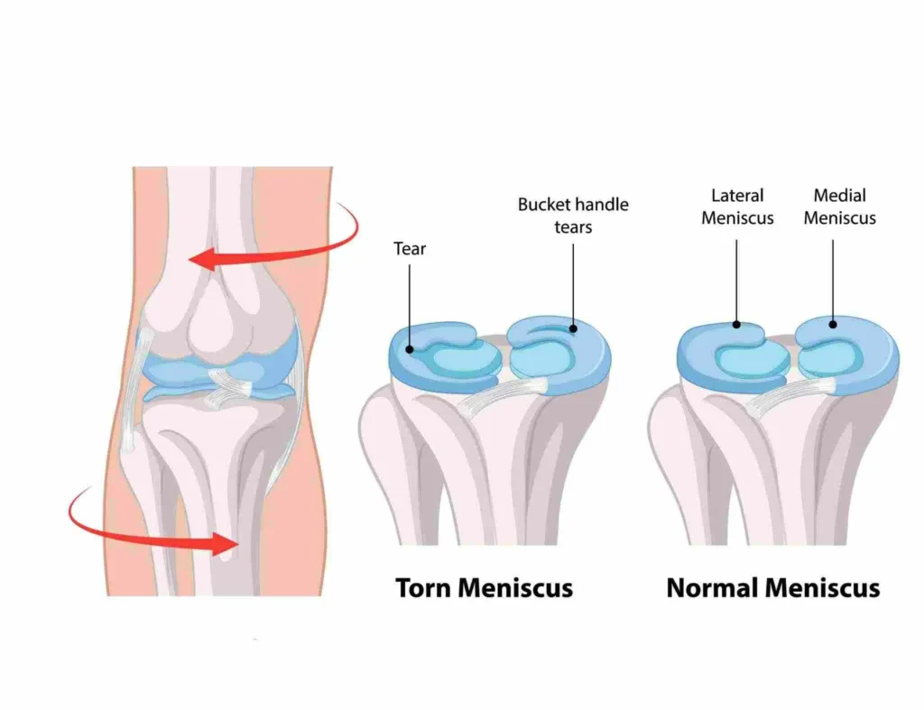 Diagram of the knee joint featuring different types, emphasizing the role of a knee brace for meniscus tear recovery.